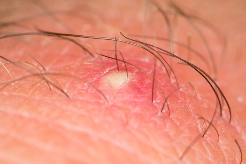 causas foliculitis
